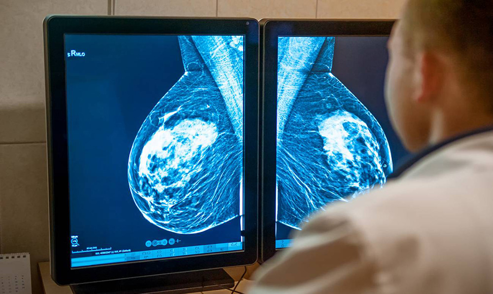mujeres con cancer de mama podran evitar la quimioterapia
